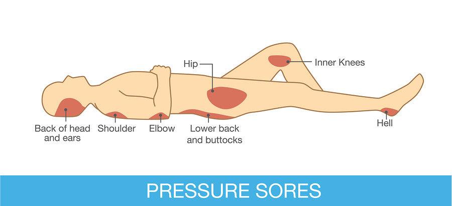 Dealing with Pressure Sores - Airospring